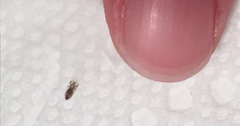 How To Spot Head Lice And Keep Them From Returning